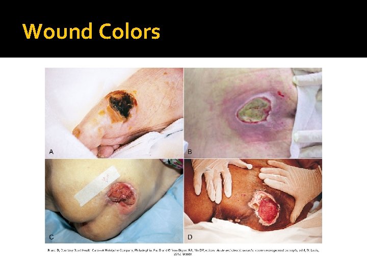 Wound Colors 