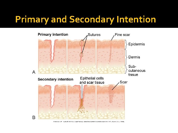 Primary and Secondary Intention 