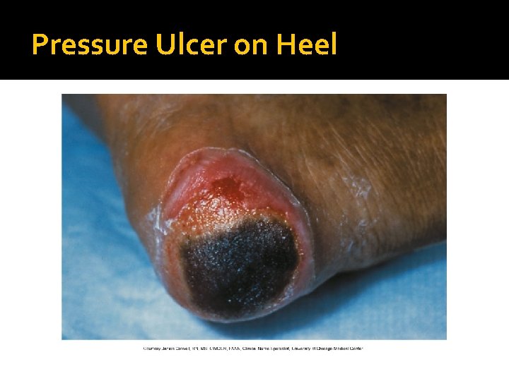 Pressure Ulcer on Heel 