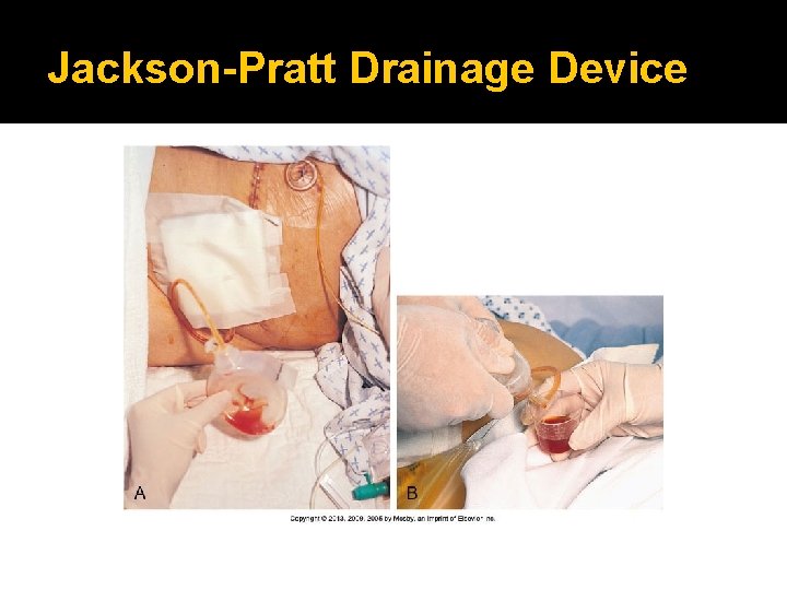 Jackson-Pratt Drainage Device 