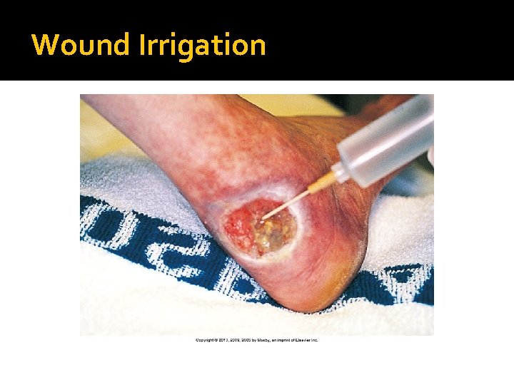 Wound Irrigation 