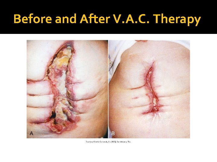 Before and After V. A. C. Therapy 