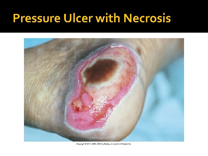 Pressure Ulcer with Necrosis 