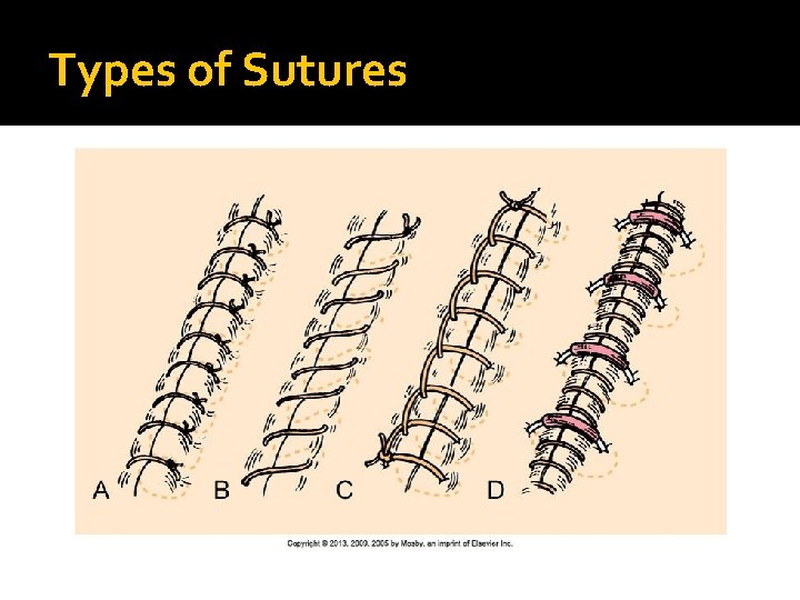 Types of Sutures 