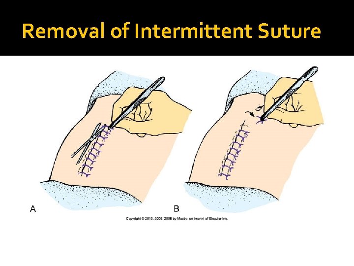 Removal of Intermittent Suture 