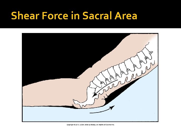 Shear Force in Sacral Area 