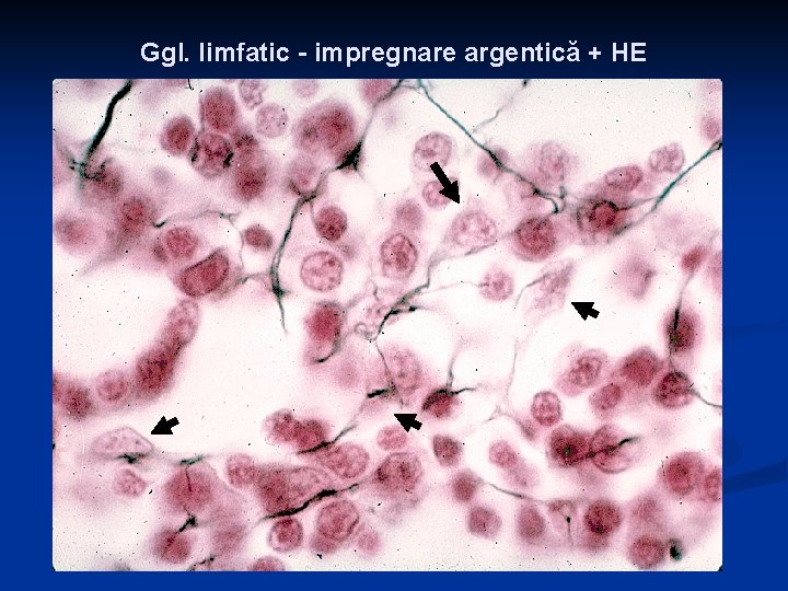 Ggl. limfatic - impregnare argentică + HE Ggl. limfatic - impregnare argentică + HE
