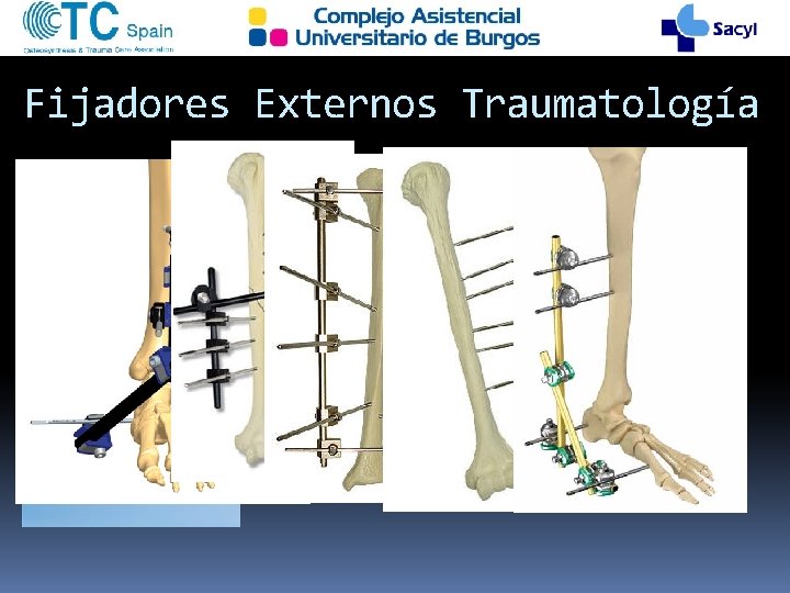 Fijadores Externos Traumatología 