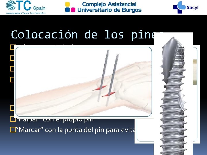 Colocación de los pines �Diámetro <1/3 del hueso Diámetro pin Hueso �Incisiones longitudinales �Disección