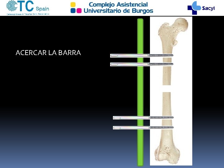 ACERCAR LA BARRA 