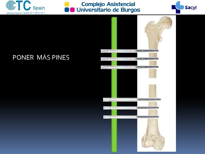 PONER MÁS PINES 
