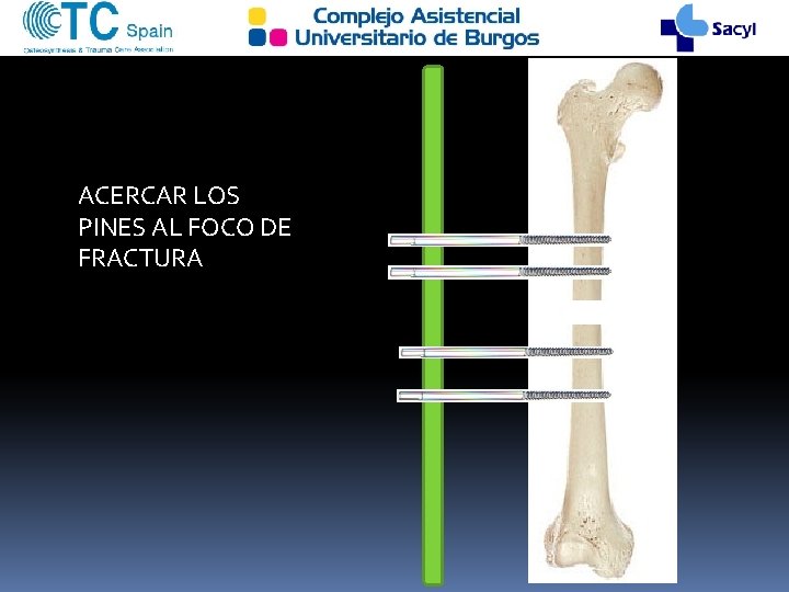 ACERCAR LOS PINES AL FOCO DE FRACTURA 