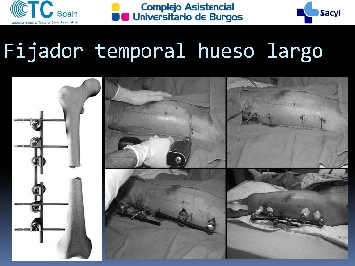 Fijador temporal hueso largo 