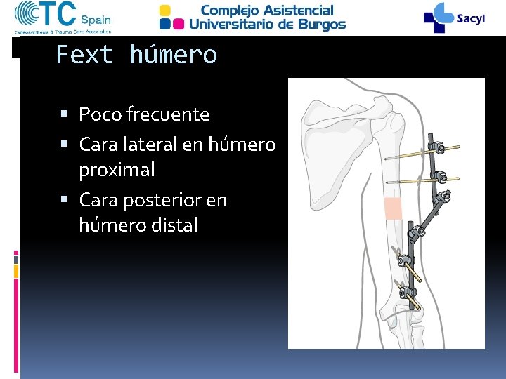 Fext húmero Poco frecuente Cara lateral en húmero proximal Cara posterior en húmero distal