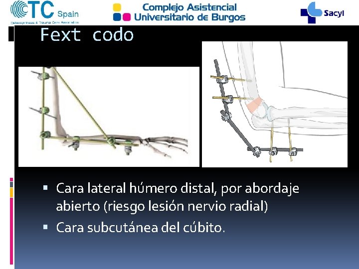 Fext codo Cara lateral húmero distal, por abordaje abierto (riesgo lesión nervio radial) Cara