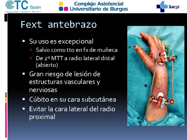 Fext antebrazo Su uso es excepcional Salvo como tto en fx de muñeca De