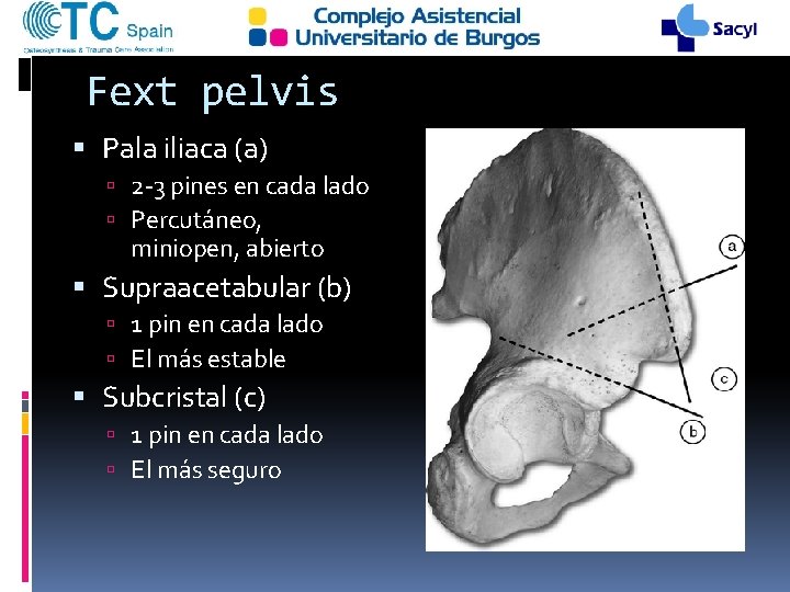 Fext pelvis Pala iliaca (a) 2 -3 pines en cada lado Percutáneo, miniopen, abierto