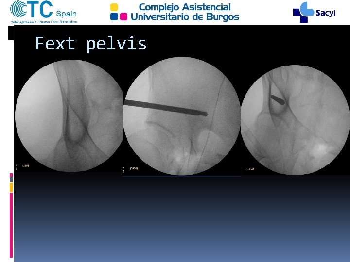 Fext pelvis 