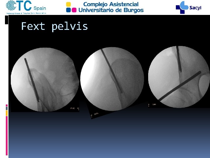 Fext pelvis 