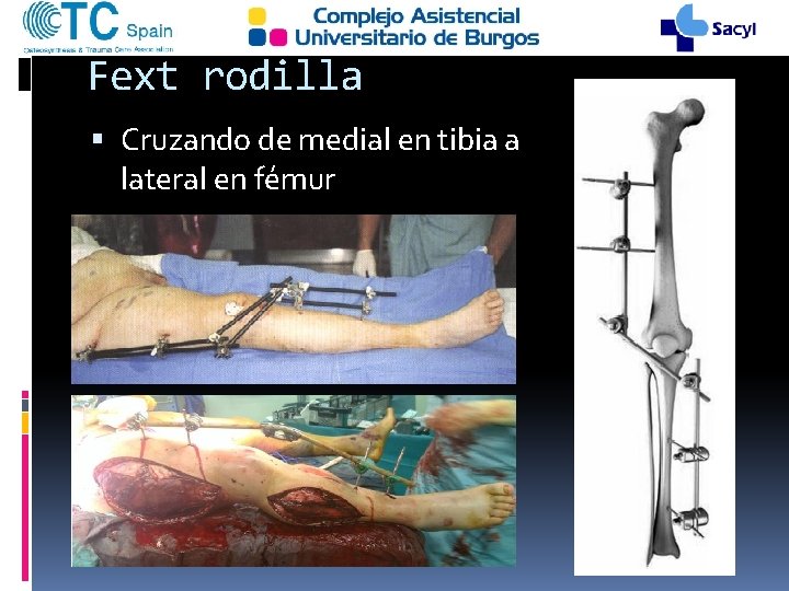 Fext rodilla Cruzando de medial en tibia a lateral en fémur 