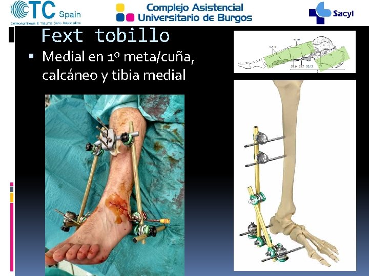 Fext tobillo Medial en 1º meta/cuña, calcáneo y tibia medial 