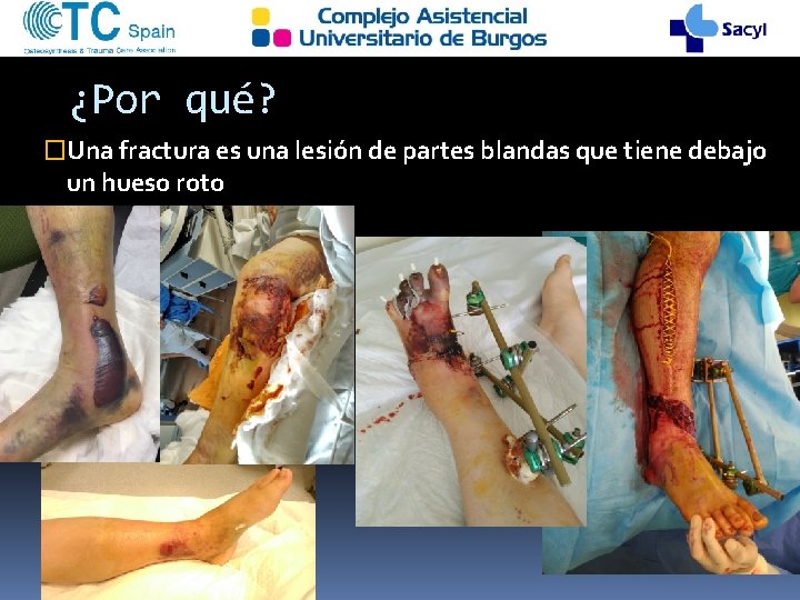 ¿Por qué? �Una fractura es una lesión de partes blandas que tiene debajo un