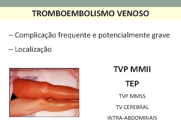 TROMBOEMBOLISMO VENOSO – Complicação frequente e potencialmente grave – Localização TVP MMII TEP TVP
