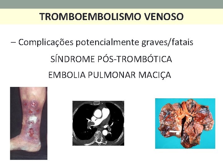 TROMBOEMBOLISMO VENOSO – Complicações potencialmente graves/fatais SÍNDROME PÓS-TROMBÓTICA EMBOLIA PULMONAR MACIÇA 