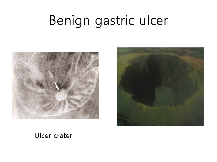 Benign gastric ulcer Ulcer crater Benign gastric ulcer Ulcer crater