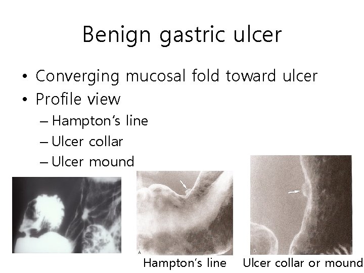 Benign gastric ulcer • Converging mucosal fold toward ulcer • Profile view – Hampton’s Benign gastric ulcer • Converging mucosal fold toward ulcer • Profile view – Hampton’s