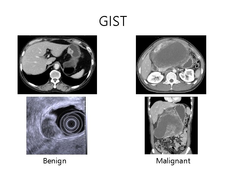 GIST Benign Malignant GIST Benign Malignant