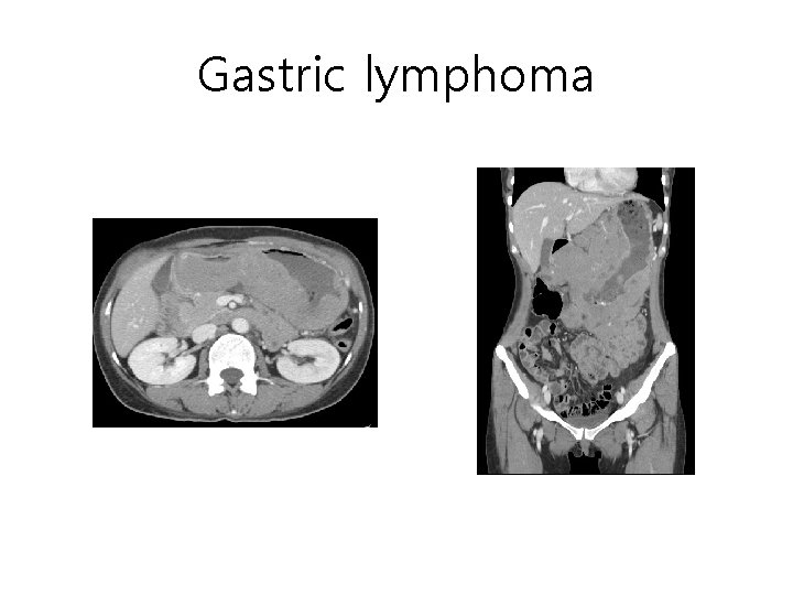 Gastric lymphoma Gastric lymphoma