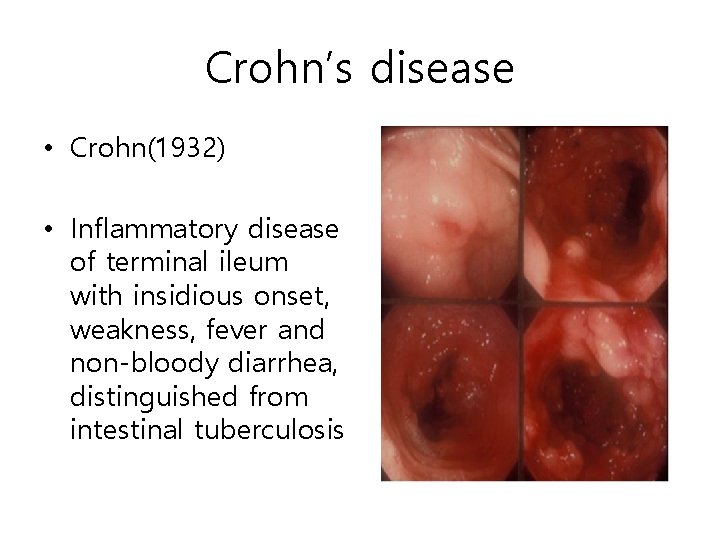 Crohn’s disease • Crohn(1932) • Inflammatory disease of terminal ileum with insidious onset, weakness, Crohn’s disease • Crohn(1932) • Inflammatory disease of terminal ileum with insidious onset, weakness,