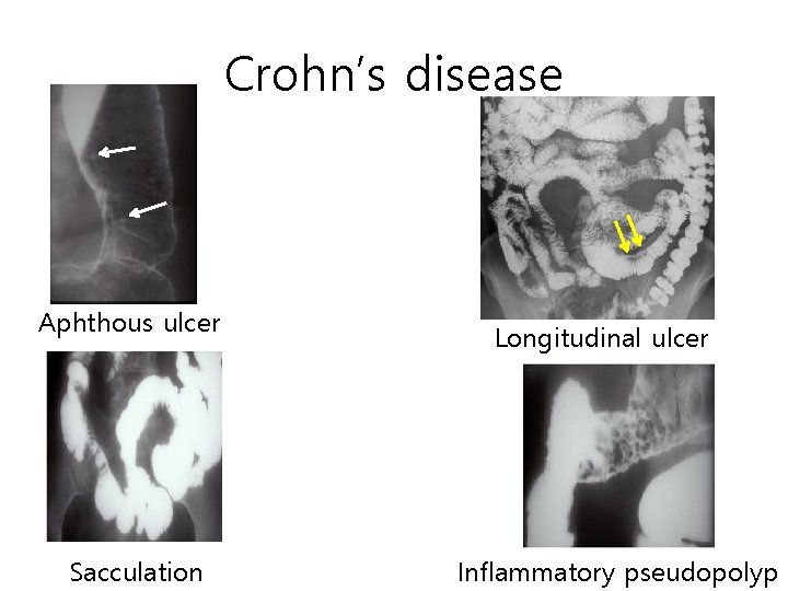 Crohn’s disease Aphthous ulcer Sacculation Longitudinal ulcer Inflammatory pseudopolyp Crohn’s disease Aphthous ulcer Sacculation Longitudinal ulcer Inflammatory pseudopolyp