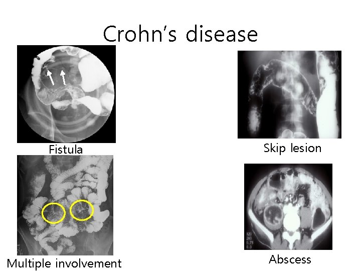 Crohn’s disease Fistula Skip lesion Multiple involvement Abscess Crohn’s disease Fistula Skip lesion Multiple involvement Abscess