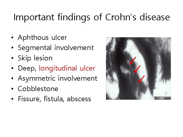 Important findings of Crohn’s disease • • Aphthous ulcer Segmental involvement Skip lesion Deep, Important findings of Crohn’s disease • • Aphthous ulcer Segmental involvement Skip lesion Deep,