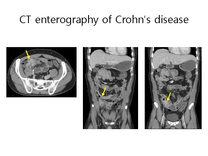 CT enterography of Crohn’s disease CT enterography of Crohn’s disease