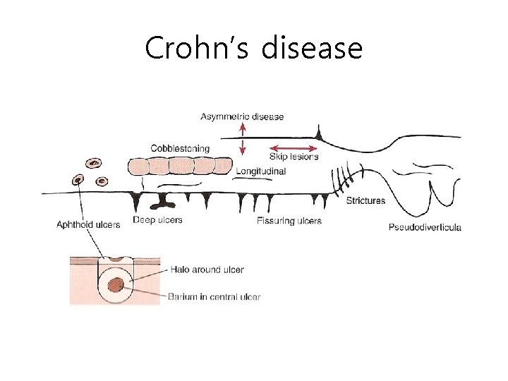Crohn’s disease Crohn’s disease
