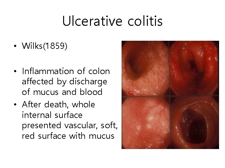 Ulcerative colitis • Wilks(1859) • Inflammation of colon affected by discharge of mucus and Ulcerative colitis • Wilks(1859) • Inflammation of colon affected by discharge of mucus and