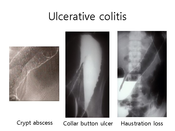Ulcerative colitis Crypt abscess Collar button ulcer Haustration loss Ulcerative colitis Crypt abscess Collar button ulcer Haustration loss