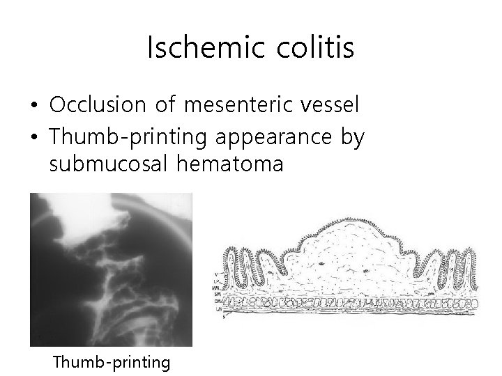 Ischemic colitis • Occlusion of mesenteric vessel • Thumb-printing appearance by submucosal hematoma Thumb-printing Ischemic colitis • Occlusion of mesenteric vessel • Thumb-printing appearance by submucosal hematoma Thumb-printing