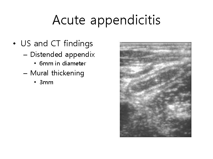 Acute appendicitis • US and CT findings – Distended appendix • 6 mm in Acute appendicitis • US and CT findings – Distended appendix • 6 mm in