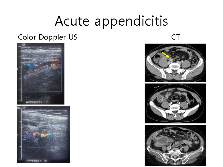Acute appendicitis Color Doppler US CT Acute appendicitis Color Doppler US CT