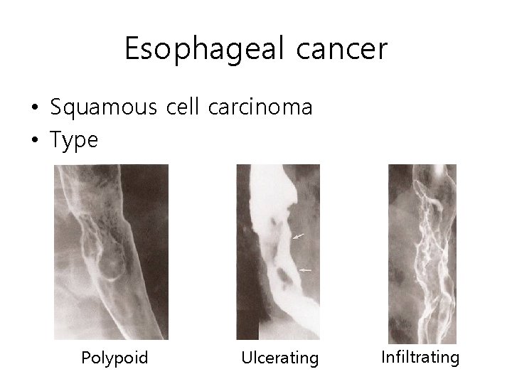 Esophageal cancer • Squamous cell carcinoma • Type Polypoid Ulcerating Infiltrating Esophageal cancer • Squamous cell carcinoma • Type Polypoid Ulcerating Infiltrating