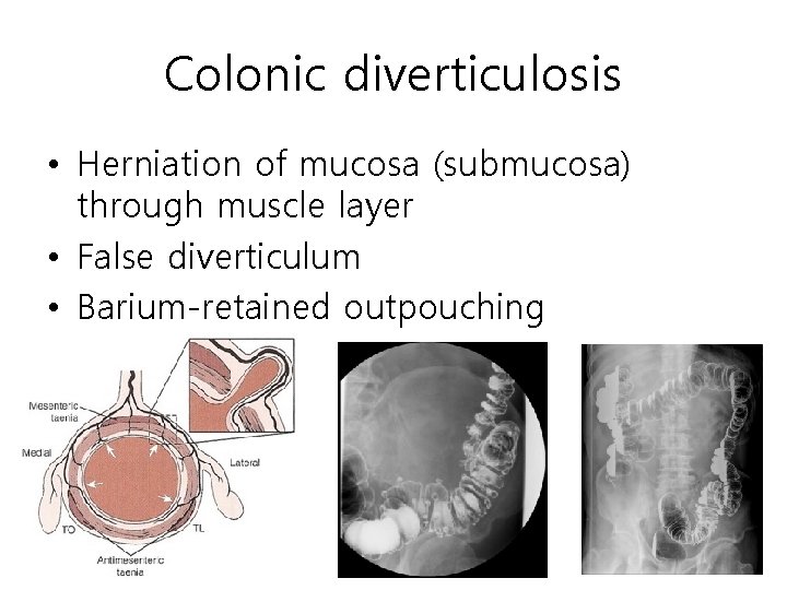Colonic diverticulosis • Herniation of mucosa (submucosa) through muscle layer • False diverticulum • Colonic diverticulosis • Herniation of mucosa (submucosa) through muscle layer • False diverticulum •