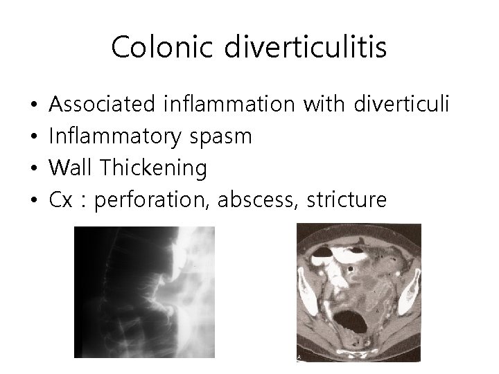 Colonic diverticulitis • • Associated inflammation with diverticuli Inflammatory spasm Wall Thickening Cx : Colonic diverticulitis • • Associated inflammation with diverticuli Inflammatory spasm Wall Thickening Cx :