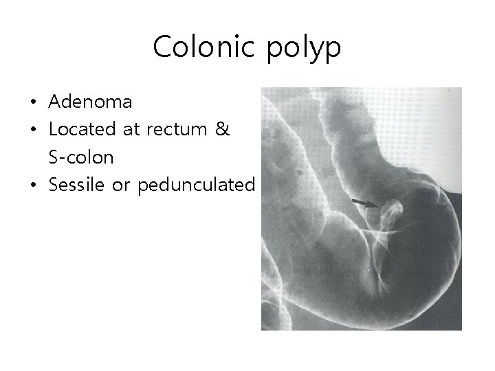 Colonic polyp • Adenoma • Located at rectum & S-colon • Sessile or pedunculated Colonic polyp • Adenoma • Located at rectum & S-colon • Sessile or pedunculated