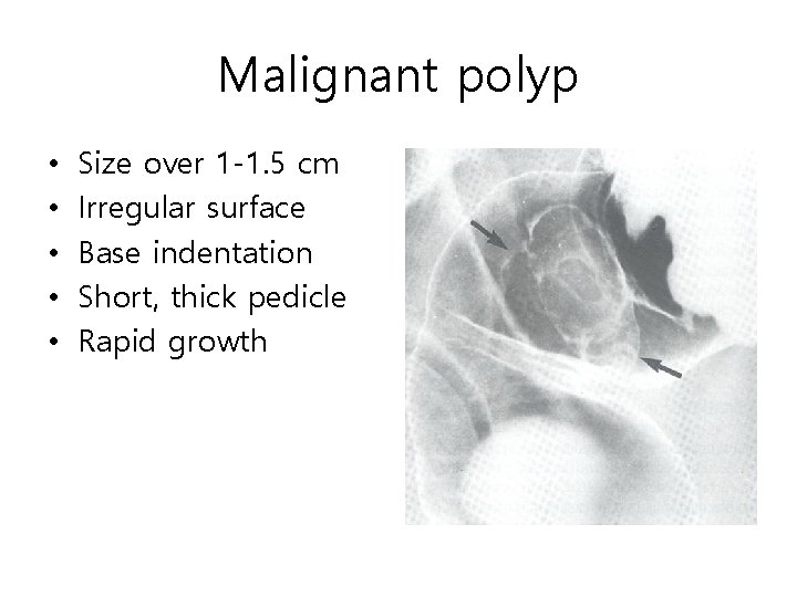 Malignant polyp • • • Size over 1 -1. 5 cm Irregular surface Base Malignant polyp • • • Size over 1 -1. 5 cm Irregular surface Base