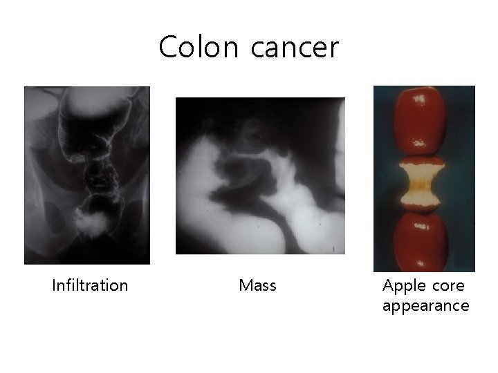 Colon cancer Infiltration Mass Apple core appearance Colon cancer Infiltration Mass Apple core appearance