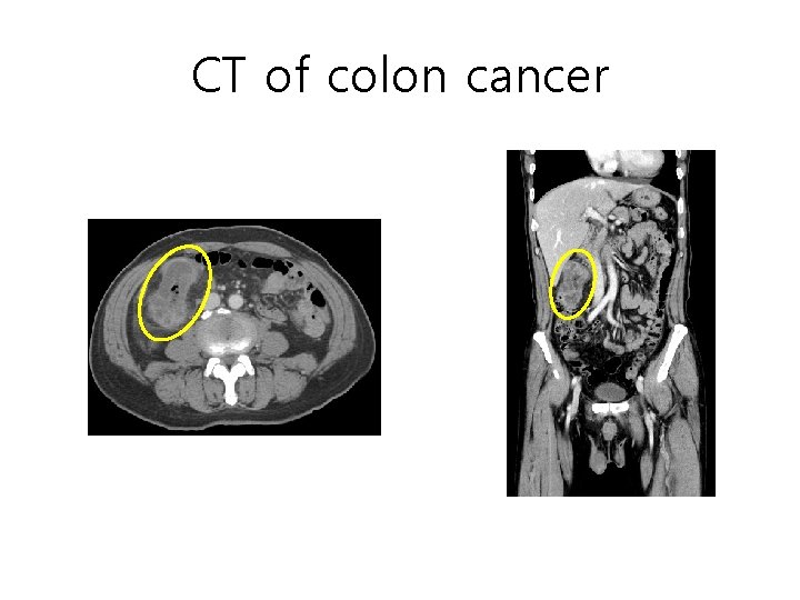 CT of colon cancer CT of colon cancer